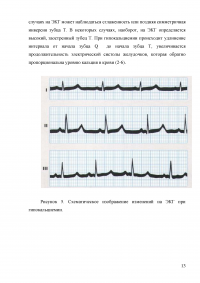 Изменеия ЭКГ при электролитных нарушениях и влиянии некоторых лекарственных препаратов Образец 4912