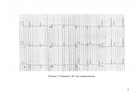Изменеия ЭКГ при электролитных нарушениях и влиянии некоторых лекарственных препаратов Образец 4907